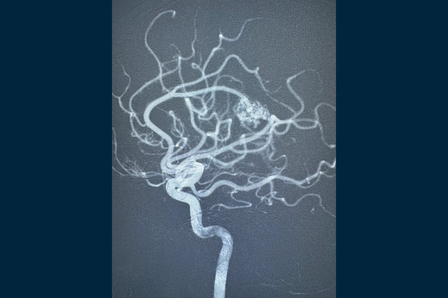 Malformaciones arteriovenosas cerebrales